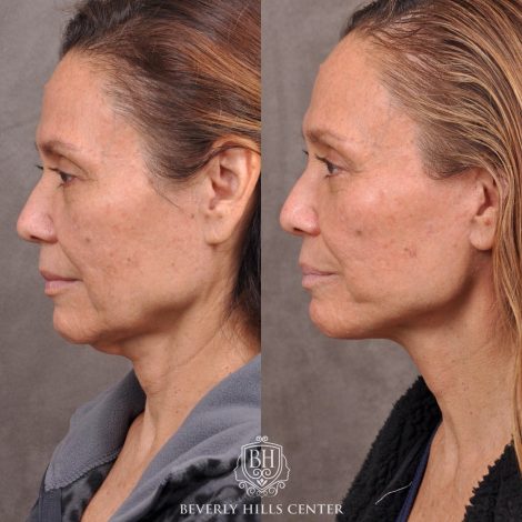 Beverly Hills Center Female Patient Before and After Brow Lift, Upper and Lower Bleph and Comprehensive Auralyft with Ptosis Repair