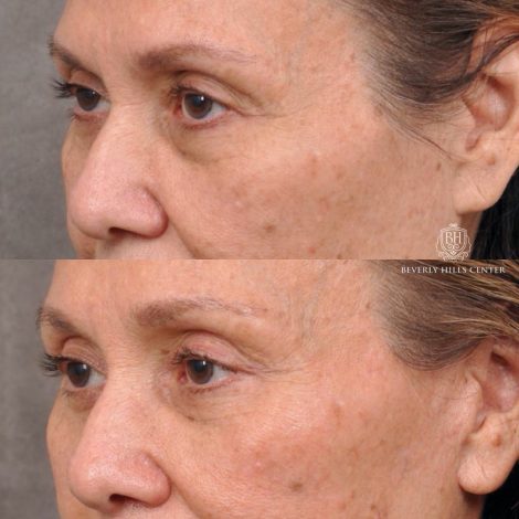 Beverly Hills Center Female Patient Before and After Brow Lift, Upper and Lower Bleph and Comprehensive Auralyft with Ptosis Repair