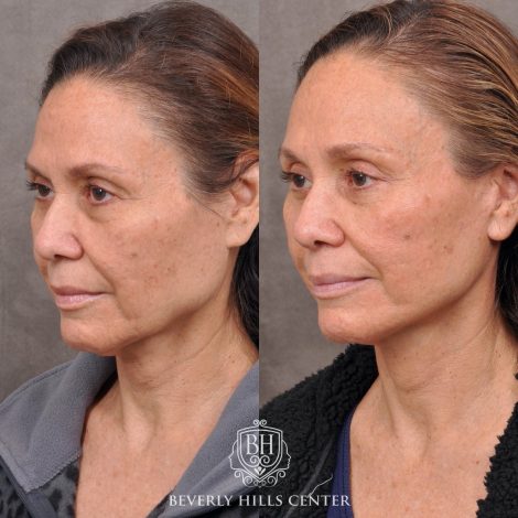 Beverly Hills Center Female Patient Before and After Brow Lift, Upper and Lower Bleph and Comprehensive Auralyft with Ptosis Repair