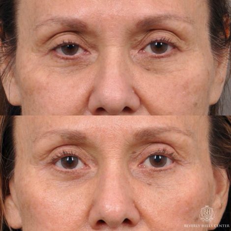 Beverly Hills Center Female Patient Before and After Brow Lift, Upper and Lower Bleph and Comprehensive Auralyft with Ptosis Repair