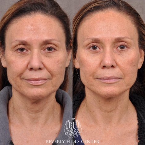 Beverly Hills Center Female Patient Before and After Brow Lift, Upper and Lower Bleph and Comprehensive Auralyft with Ptosis Repair