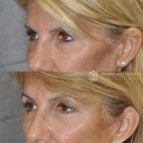 Beverly Hills Center Female Patient Before and After Facial Rejuvenation Procedures