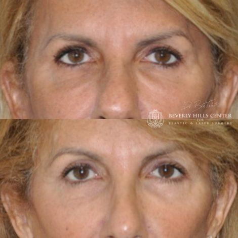 Beverly Hills Center Female Patient Before and After Facial Rejuvenation Procedures