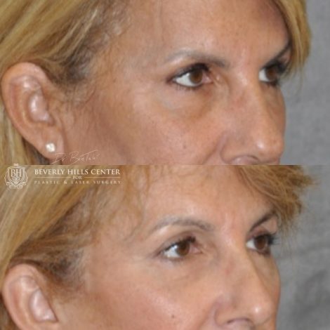 Beverly Hills Center Female Patient Before and After Facial Rejuvenation Procedures