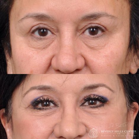 Beverly Hills Center Female Patient Before and After AuraLyft with upper and lower eyelid and lip lift