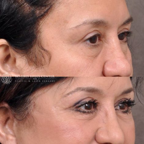 Beverly Hills Center Female Patient Before and After AuraLyft with upper and lower eyelid and lip lift