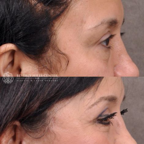 Beverly Hills Center Female Patient Before and After AuraLyft with upper and lower eyelid and lip lift