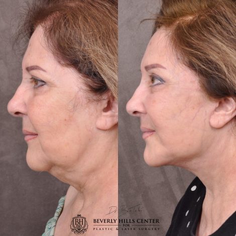 Beverly Hills Center Female Patient Before and After Revision Auralyft with Mini Brow Lift and Upper Blepharoplasty