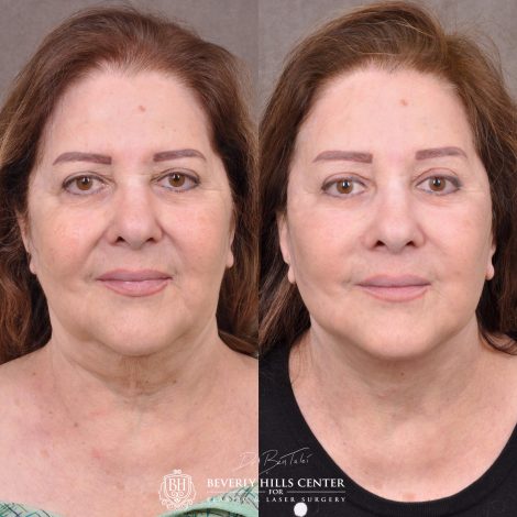 Beverly Hills Center Female Patient Before and After Revision Auralyft with Mini Brow Lift and Upper Blepharoplasty