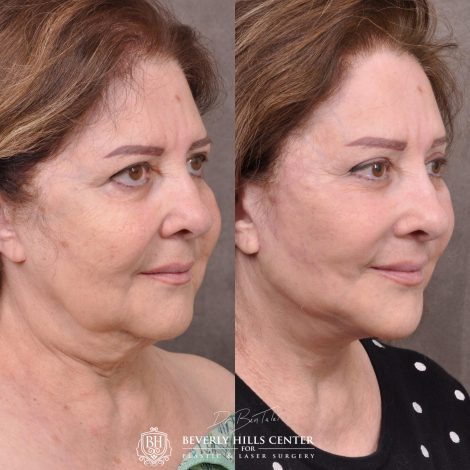 Beverly Hills Center Female Patient Before and After Revision Auralyft with Mini Brow Lift and Upper Blepharoplasty