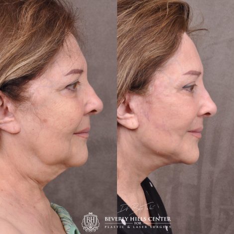 Beverly Hills Center Female Patient Before and After Revision Auralyft with Mini Brow Lift and Upper Blepharoplasty