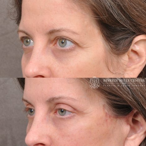 Beverly Hills Center Female Patient Before and After Facial Rejuvenation Procedures