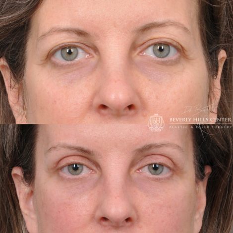 Beverly Hills Center Female Patient Before and After Facial Rejuvenation Procedures
