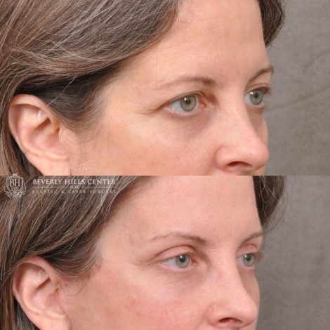Beverly Hills Center Female Patient Before and After Facial Rejuvenation Procedures