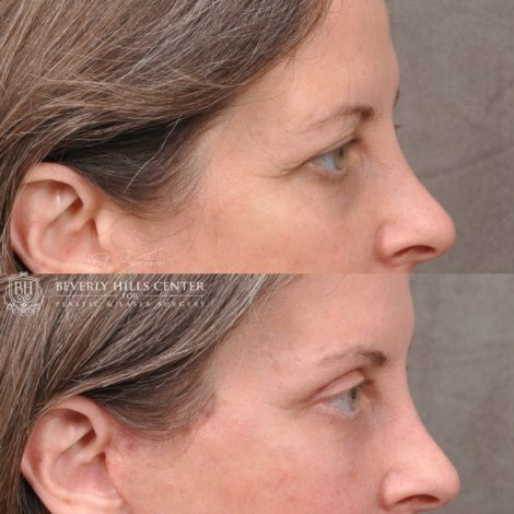 Beverly Hills Center Female Patient Before and After Facial Rejuvenation Procedures