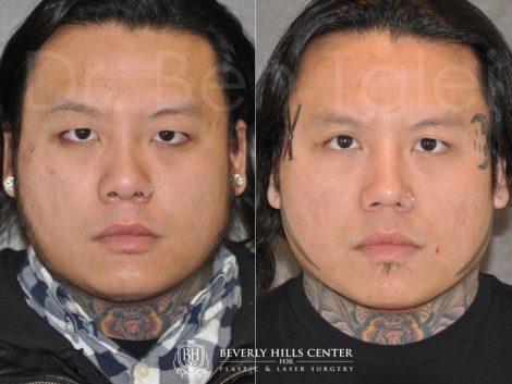 Beverly Hills Center Male Patient Before and After Asian Eyelid and Rhinoplasty Procedures