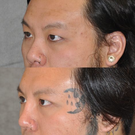 Beverly Hills Center Male Patient Before and After Asian Eyelid and Rhinoplasty Procedures