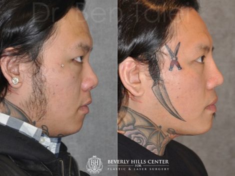 Beverly Hills Center Male Patient Before and After Asian Eyelid and Rhinoplasty Procedures