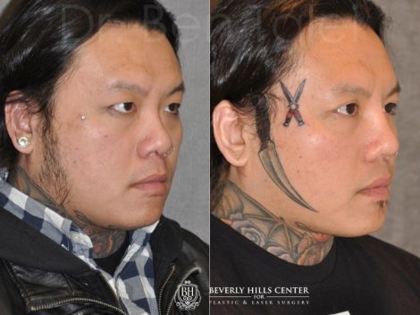 Beverly Hills Center Male Patient Before and After Asian Eyelid and Rhinoplasty Procedures