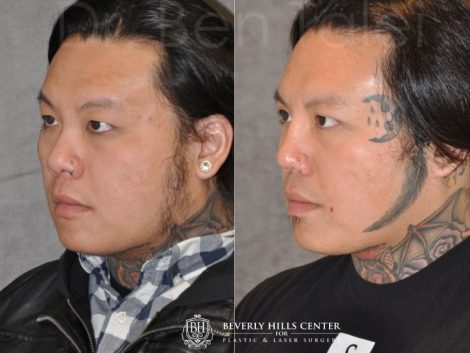 Beverly Hills Center Male Patient Before and After Asian Eyelid and Rhinoplasty Procedures