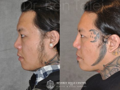 Beverly Hills Center Male Patient Before and After Asian Eyelid and Rhinoplasty Procedures