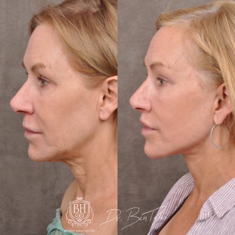 Beverly Hills Center Female Patient Before and After Laser Damage Deflation Repair - Comprehensive Aura-Lyft, Profound RF, Lip Lift & Upper and Lower Bleph