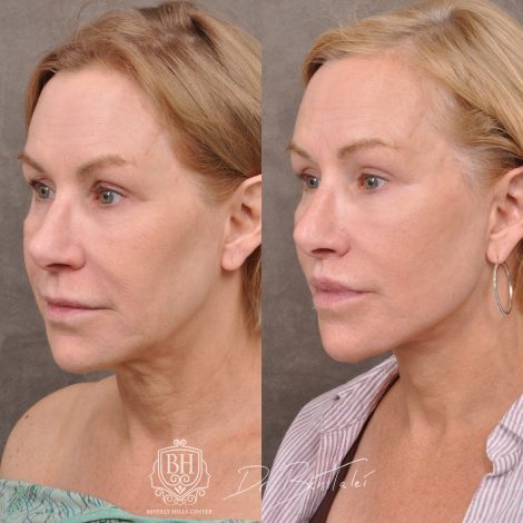 Beverly Hills Center Female Patient Before and After Laser Damage Deflation Repair - Comprehensive Aura-Lyft, Profound RF, Lip Lift & Upper and Lower Bleph