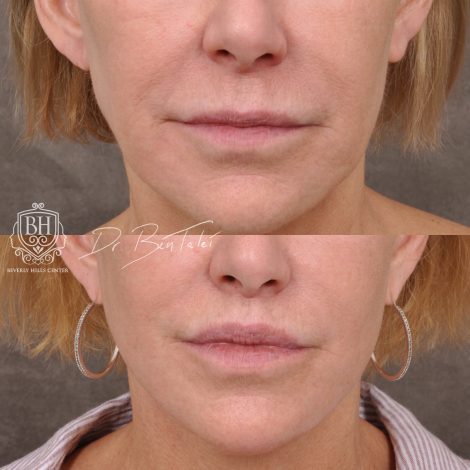 Beverly Hills Center Female Patient Before and After Laser Damage Deflation Repair - Comprehensive Aura-Lyft, Profound RF, Lip Lift & Upper and Lower Bleph
