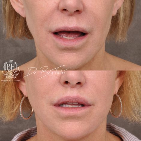 Beverly Hills Center Female Patient Before and After Laser Damage Deflation Repair - Comprehensive Aura-Lyft, Profound RF, Lip Lift & Upper and Lower Bleph