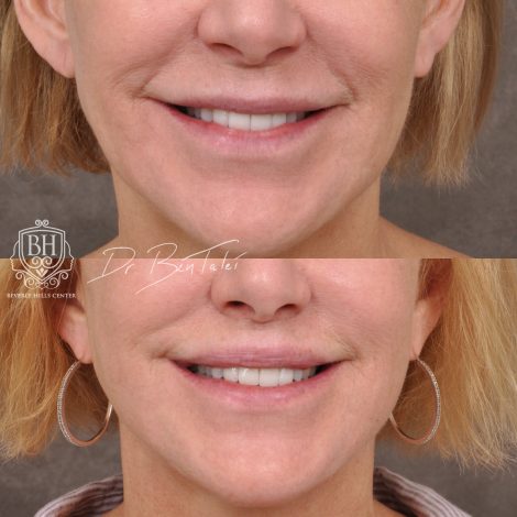 Beverly Hills Center Female Patient Before and AfterLaser Damage Deflation Repair - Comprehensive Aura-Lyft, Profound RF, Lip Lift & Upper and Lower Bleph