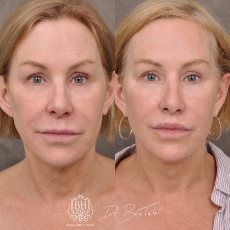 Beverly Hills Center Female Patient Before and After Laser Damage Deflation Repair - Comprehensive Aura-Lyft, Profound RF, Lip Lift & Upper and Lower Bleph