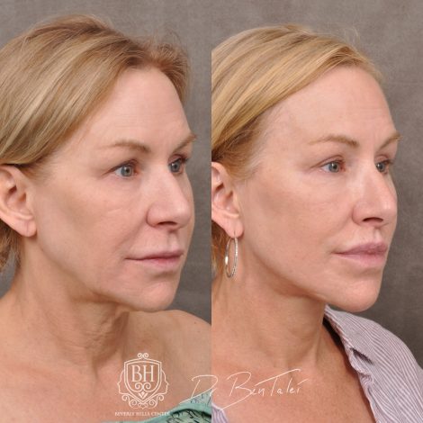 Beverly Hills Center Female Patient Before and After Laser Damage Deflation Repair - Comprehensive Aura-Lyft, Profound RF, Lip Lift & Upper and Lower Bleph