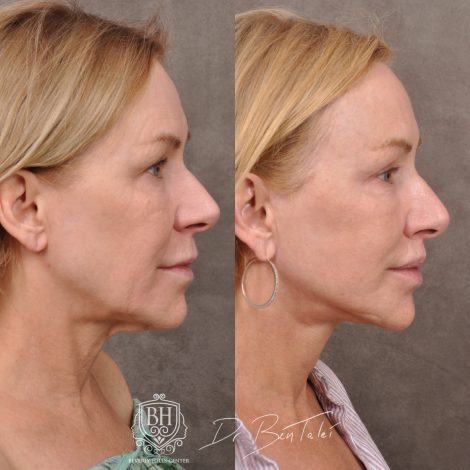 Beverly Hills Center Female Patient Before and After Laser Damage Deflation Repair - Comprehensive Aura-Lyft, Profound RF, Lip Lift & Upper and Lower Bleph