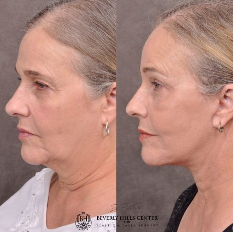 Beverly Hills Center Female Patient Before and After Auralyft Browlift Ptosis Repair Upper & Lower Eyelid Fat Repositioning