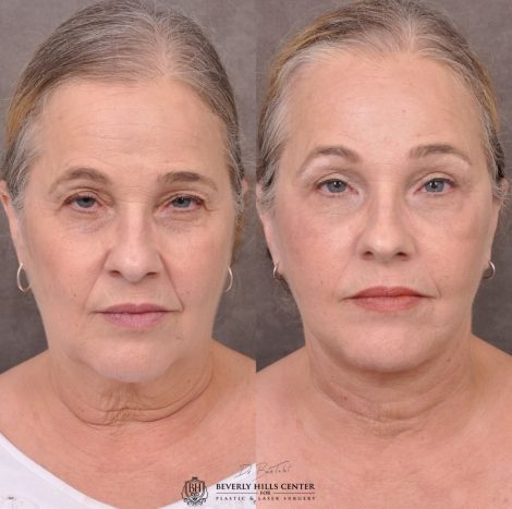 Beverly Hills Center Female Patient Before and After Auralyft Browlift Ptosis Repair Upper & Lower Eyelid Fat Repositioning