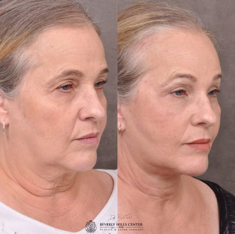 Beverly Hills Center Female Patient Before and After Auralyft Browlift Ptosis Repair Upper & Lower Eyelid Fat Repositioning