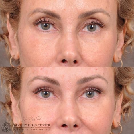 Beverly Hills Center Female Patient Before and After Non-surgical Brow Filler