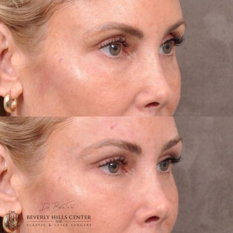 Beverly Hills Center Female Patient Before and After Non-surgical Brow Filler