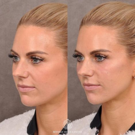 Beverly Hills Center Female Patient Before and After Botox Cheek & Chin Filler