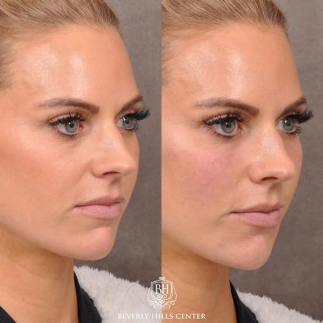 Beverly Hills Center Female Patient Before and After Botox Cheek & Chin Filler