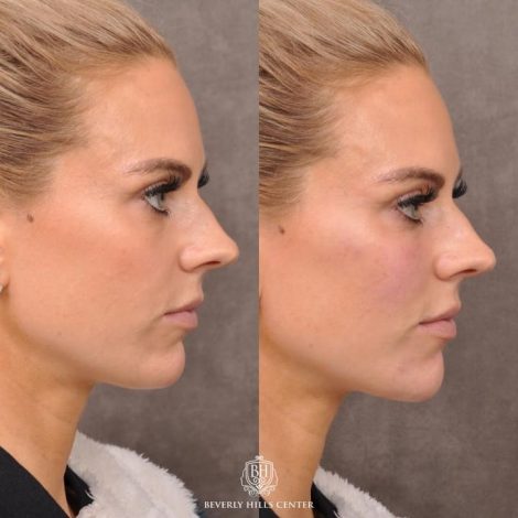 Beverly Hills Center Female Patient Before and After Botox Cheek & Chin Filler