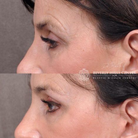 Beverly Hills Center Female Patient Before and After Facial Rejuvenation Procedures