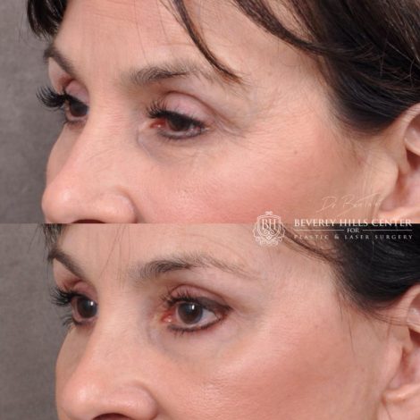 Beverly Hills Center Female Patient Before and After Facial Rejuvenation Procedures