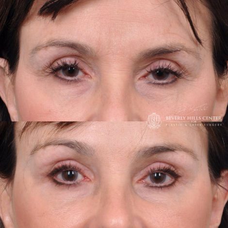 Beverly Hills Center Female Patient Before and After Facial Rejuvenation Procedures