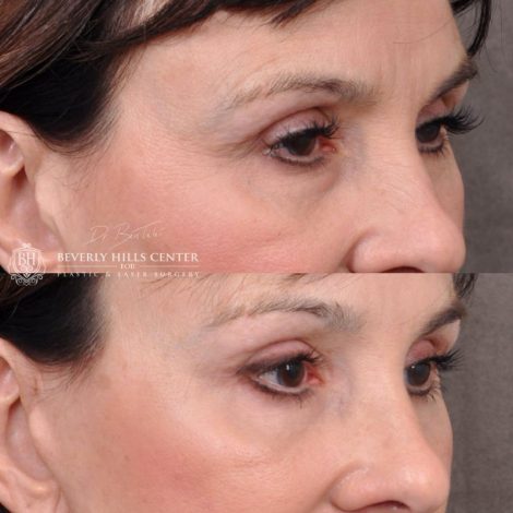 Beverly Hills Center Female Patient Before and After Facial Rejuvenation Procedures
