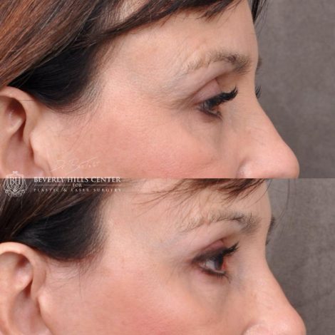 Beverly Hills Center Female Patient Before and After Facial Rejuvenation Procedures