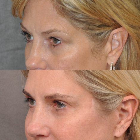 Beverly Hills Center Female Patient Before and After Facial Rejuvenation Procedures
