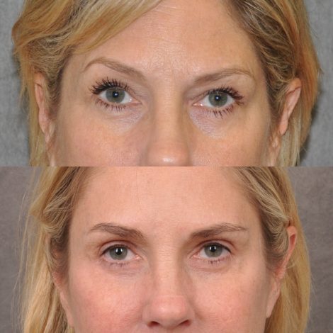 Beverly Hills Center Female Patient Before and After Facial Rejuvenation Procedures