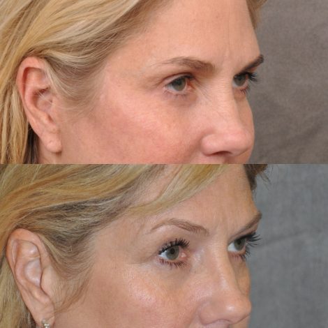 Beverly Hills Center Female Patient Before and After Facial Rejuvenation Procedures