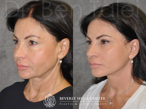 Beverly Hills Center Female Patient Before and After Auralyft with Upper and Lower Eyelid Rejuvenation